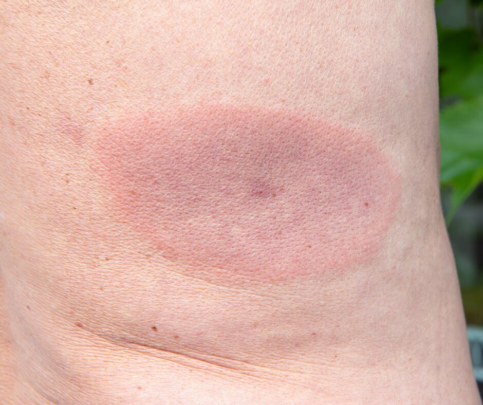 Lyme disease symptoms